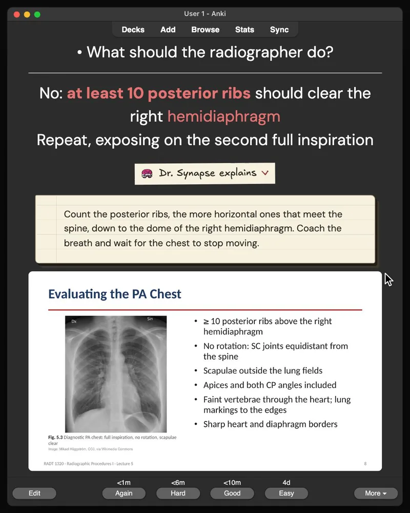 A card from the 30-card deck open in Anki: the answer, Dr. Synapse’s explanation and the lecture slide it came from