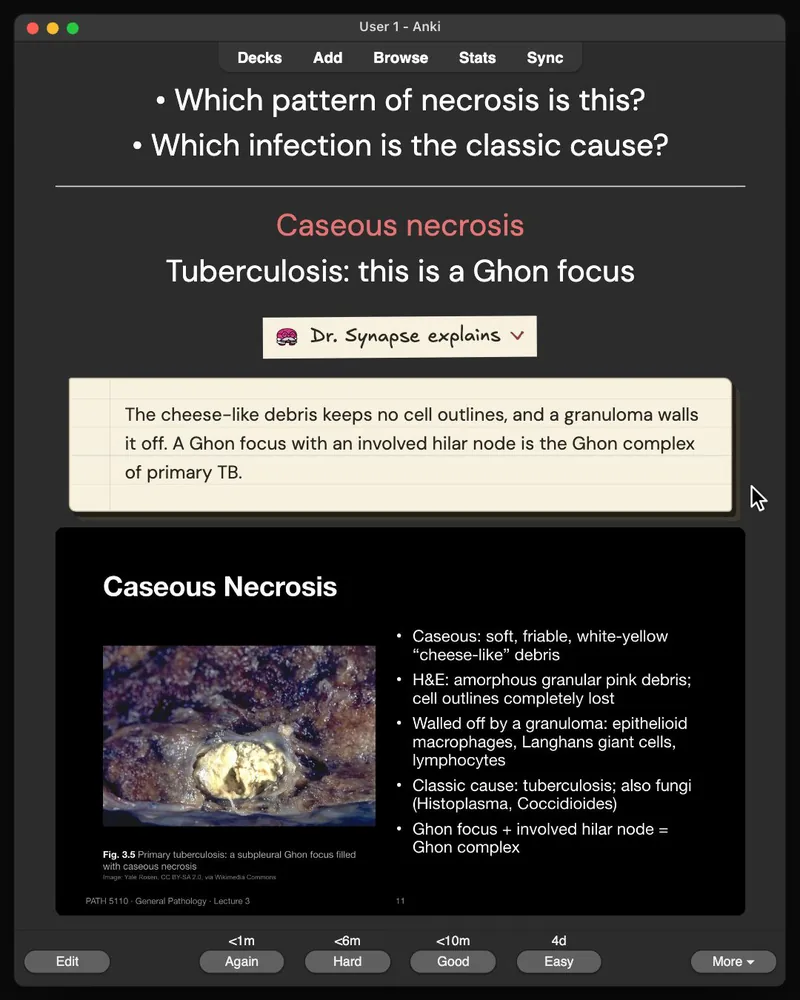 A card from the 31-card deck open in Anki: the answer, Dr. Synapse’s explanation and the lecture slide it came from